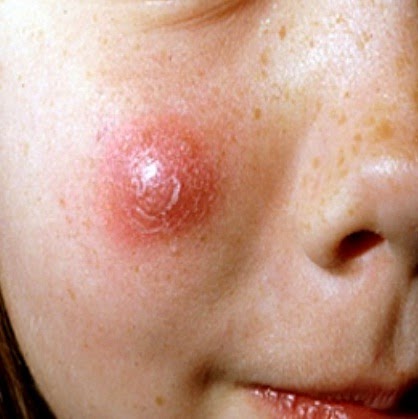 Abscess: Causes, Symptoms, Tests, and Treatment
