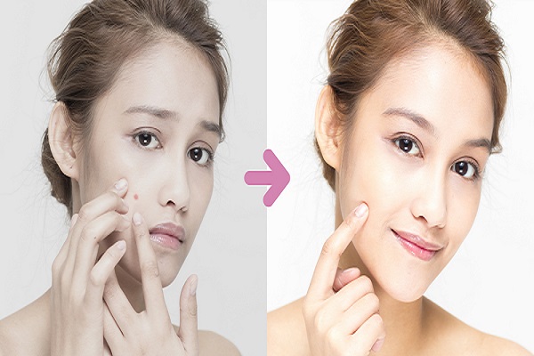 Learn How Acne Medication And Improve Lifestyle Can Work Together To Prevent Facial Acne Learn How Acne Medication And Improve Lifestyle Can Work Together To Prevent Facial Acne