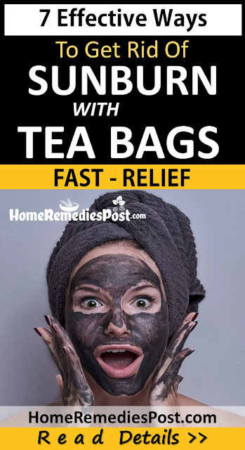 tea bags for sunburn relief, Home Remedies For Sunburn, how to treat sunburn, how to get rid of sunburn