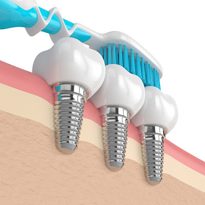 Maintenance of dental implant