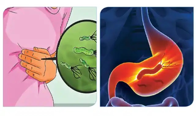 الميكروب الحلزونى أسبابه أعراضه علاجه الميكروب الحلزونى أسبابه أعراضه علاجه