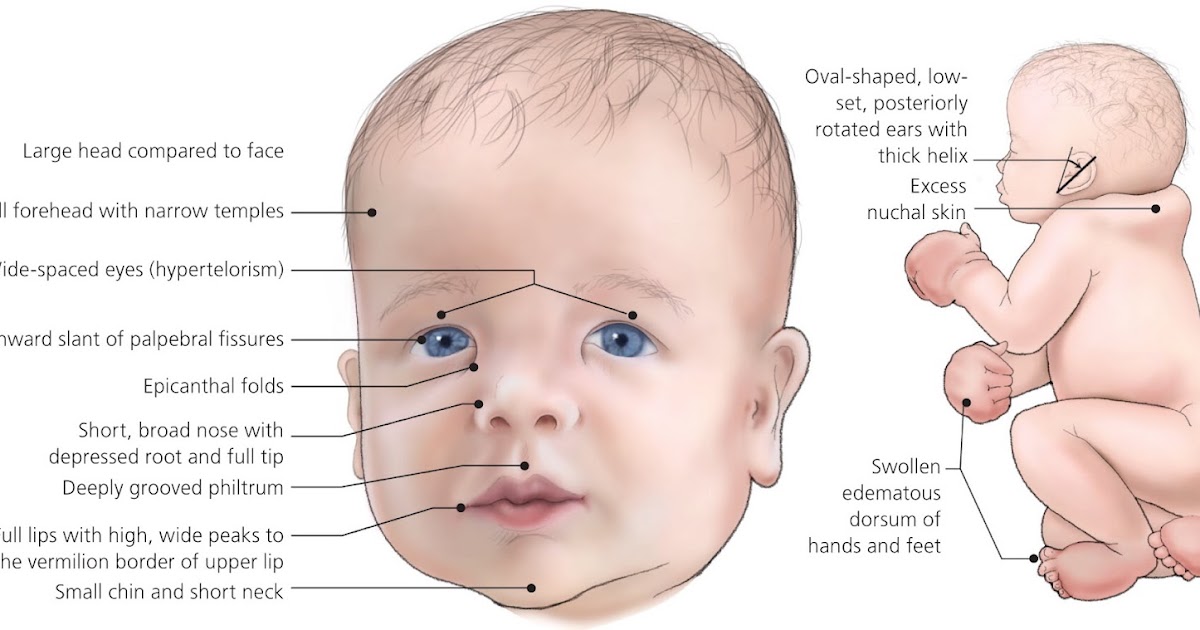 Đặc điểm khuôn mặt của trẻ mắc hội chứng rượu bào thai