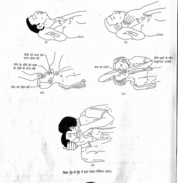 Mouth to mouth resuscitation mathod Mouth to mouth resuscitation mathod