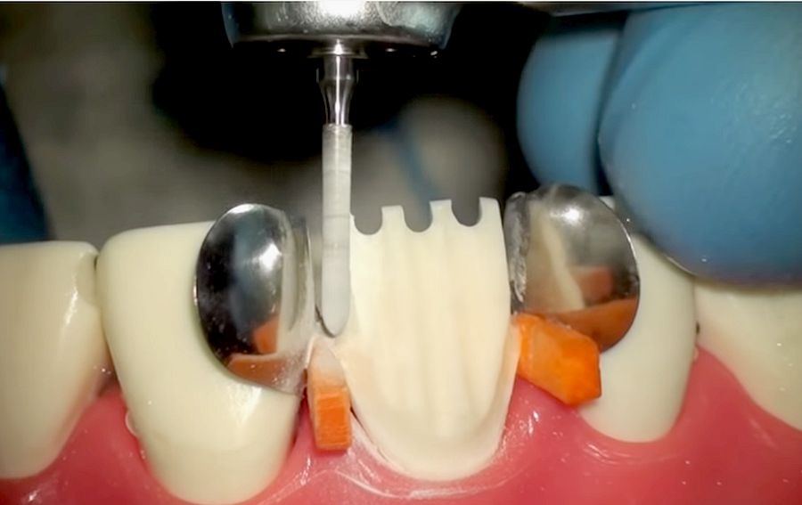 UPPER INCISOR CROWN PREPARATIONS Step by Step OdontoTv
