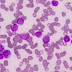 How Marijuana Destroys Cancer Cells While Leaving Healthy Cells Alone