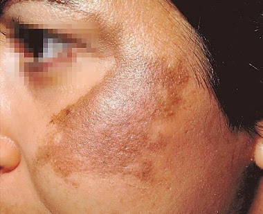 PROGRAMA CONTRA EL MELASMA