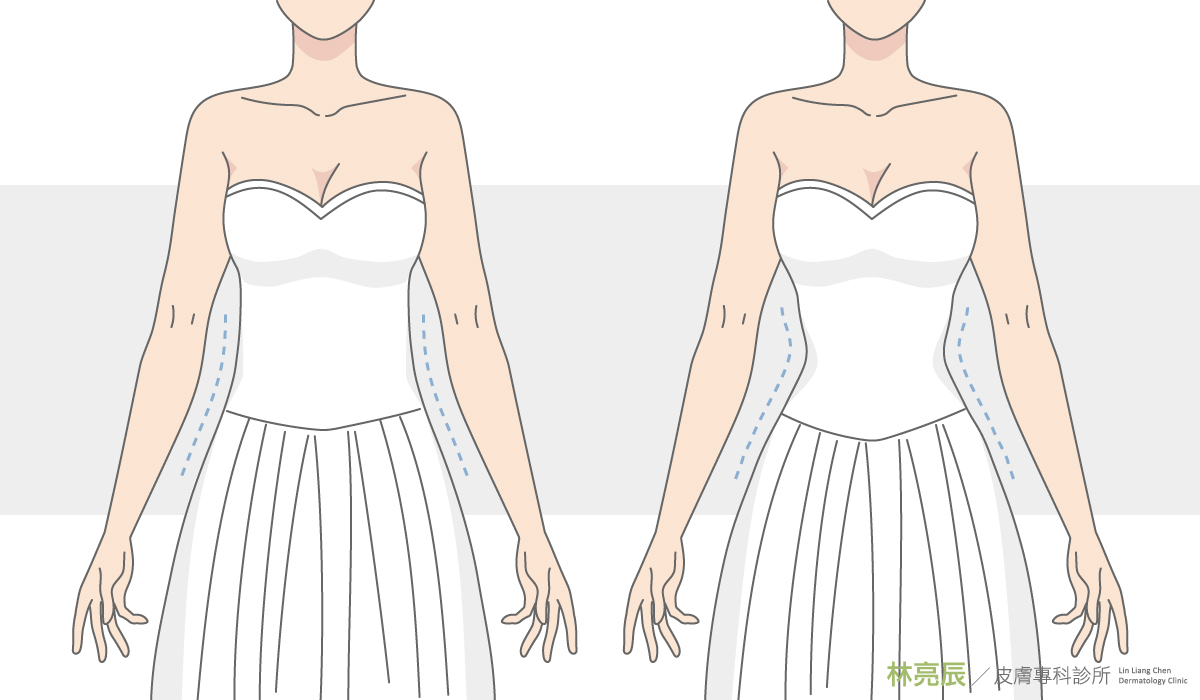 婚紗挑選魚尾冷凍減脂冷凍溶脂新竹體雕推薦非侵入式體雕SculpSure絲酷秀雷射體雕雙下巴新竹推薦診所林亮辰皮膚專科診所林亮辰醫師