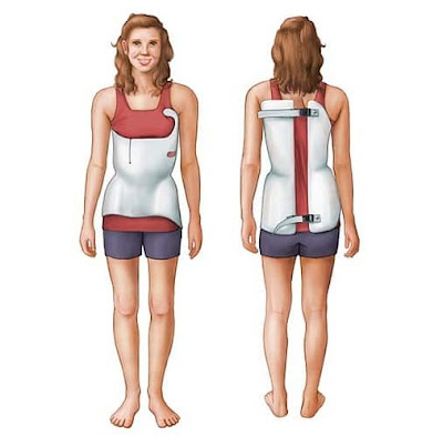 SCOLIOSIS BRACES