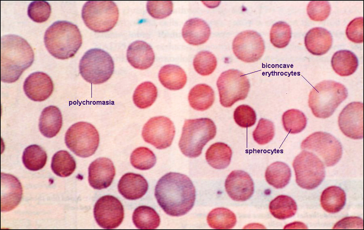 Pediatrics Notes: Laboratory Finding In Hereditary Spherocytosis