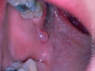 blister inside bottom lip