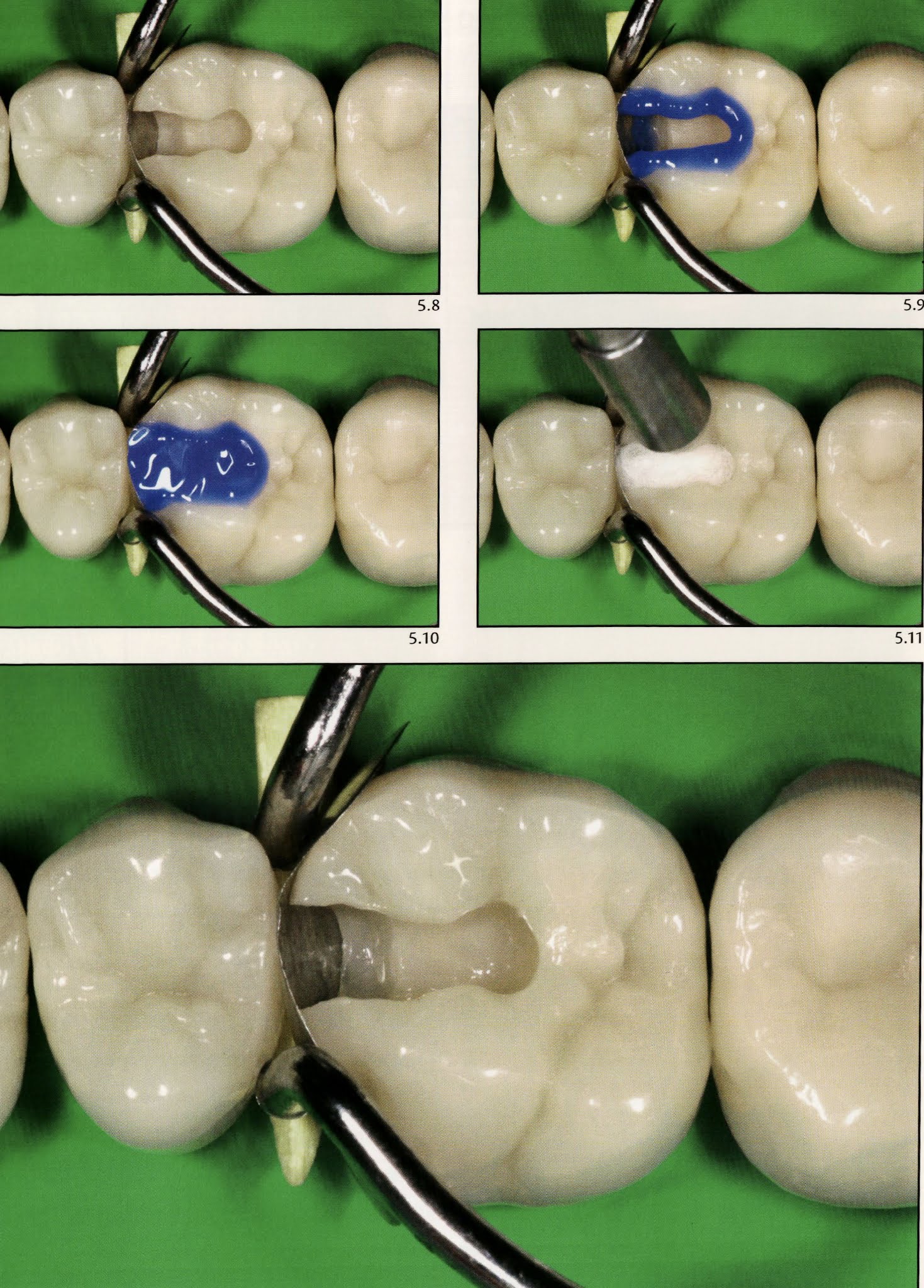 Step by step clinical adhesion 🏆 Dental Esthetics
