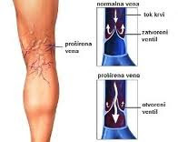 zboruri i vene varicoase)