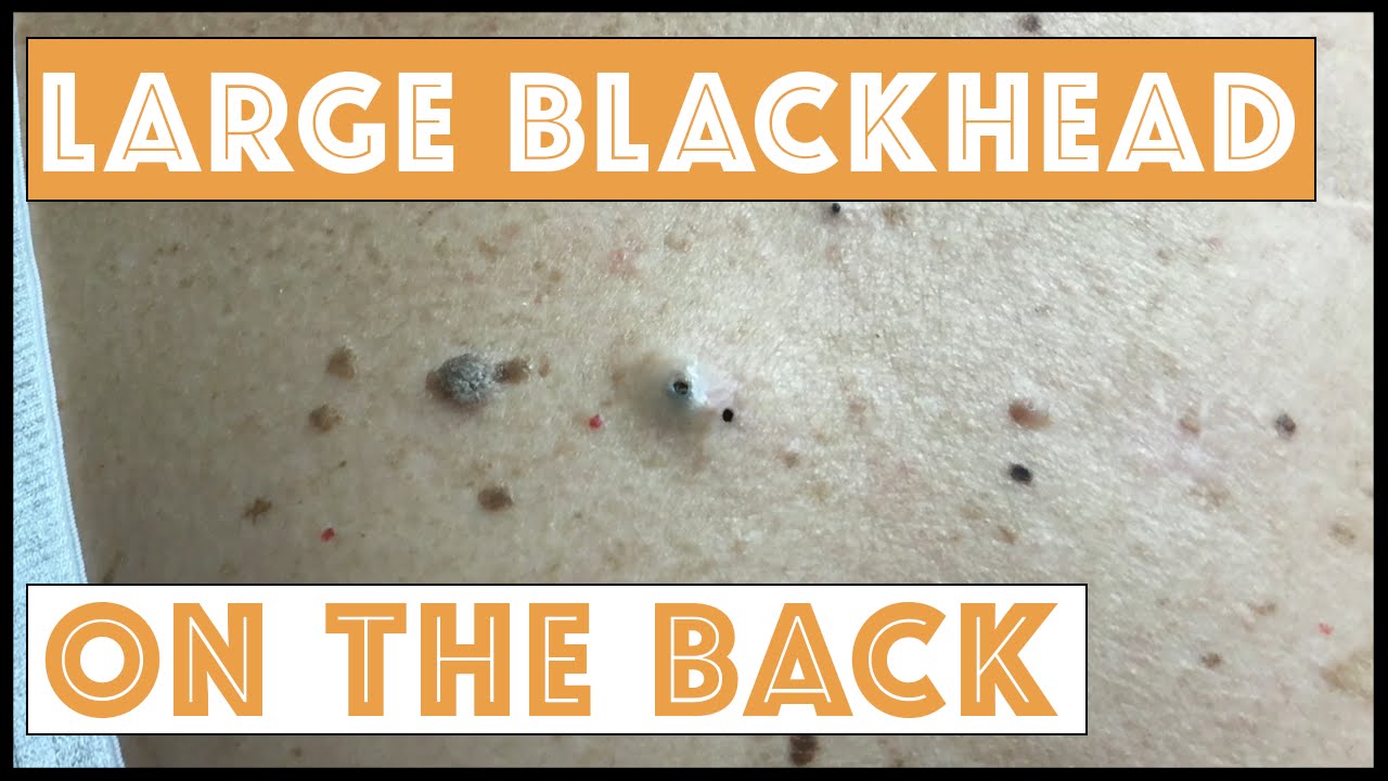 Extracting Big Blackheads on the Back ( video )