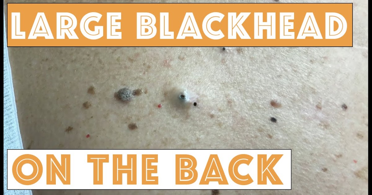 Extracting Big Blackheads on the Back ( video ) Extracting Big Blackheads on the Back ( video )