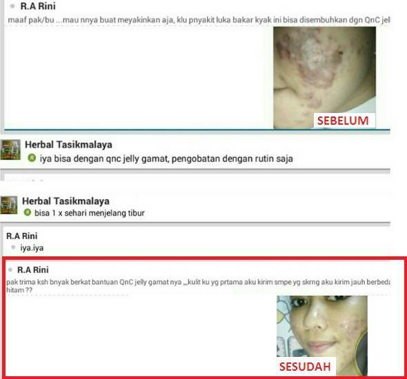 Obat Gatal Akibat Jamur Di Selangkangan yg TERBUKTI Manjur!! Obat Gatal Akibat Jamur Di Selangkangan yg TERBUKTI Manjur!!
