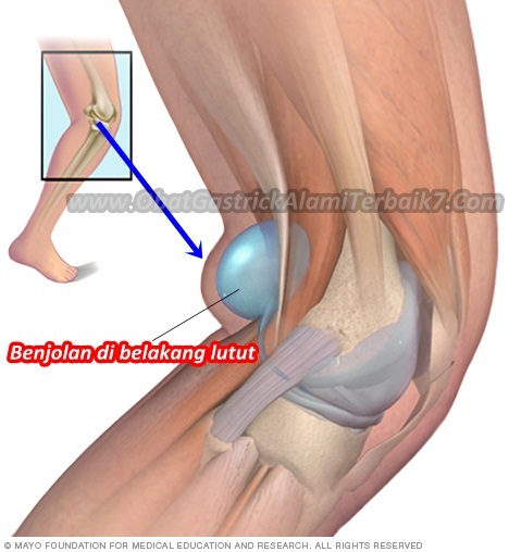 Cara Menghilangkan Benjolan Di Belakang Lutut Secara Alami 