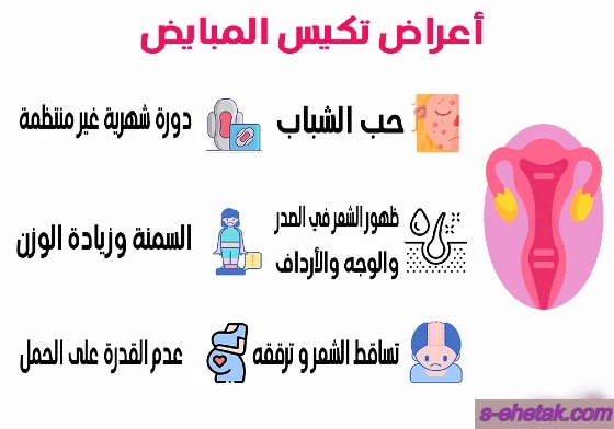 اعراض تكيس المبايض