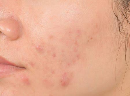 أضرار الرطوبة على البشرة وعلاجها أضرار الرطوبة على البشرة وعلاجها