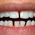 Bọc răng sứ Zirconia ở nha khoa nào tốt?