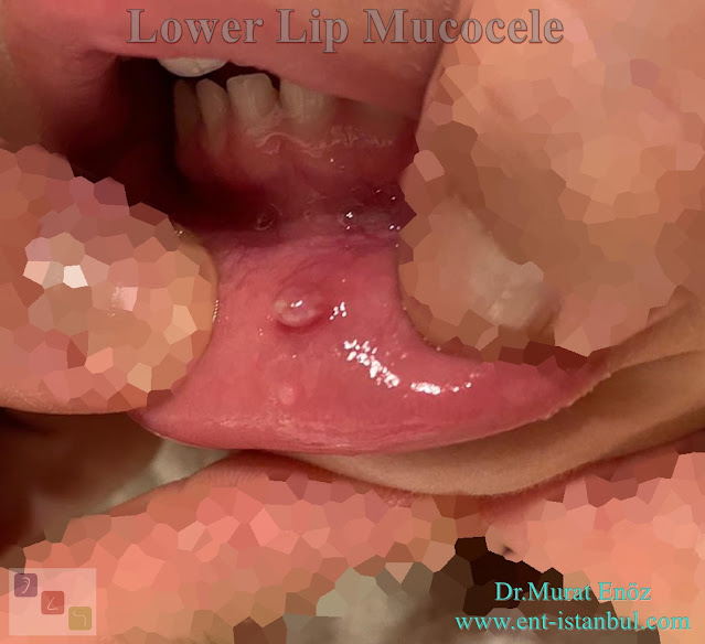Lower Lip Mucocele,Retention Mucocele on The Lower Lip,