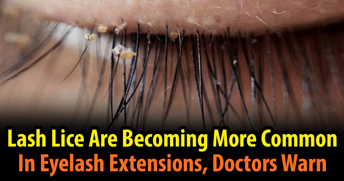 Lash Lice Are More Common In Eyelash Extensions, Doctors Warn