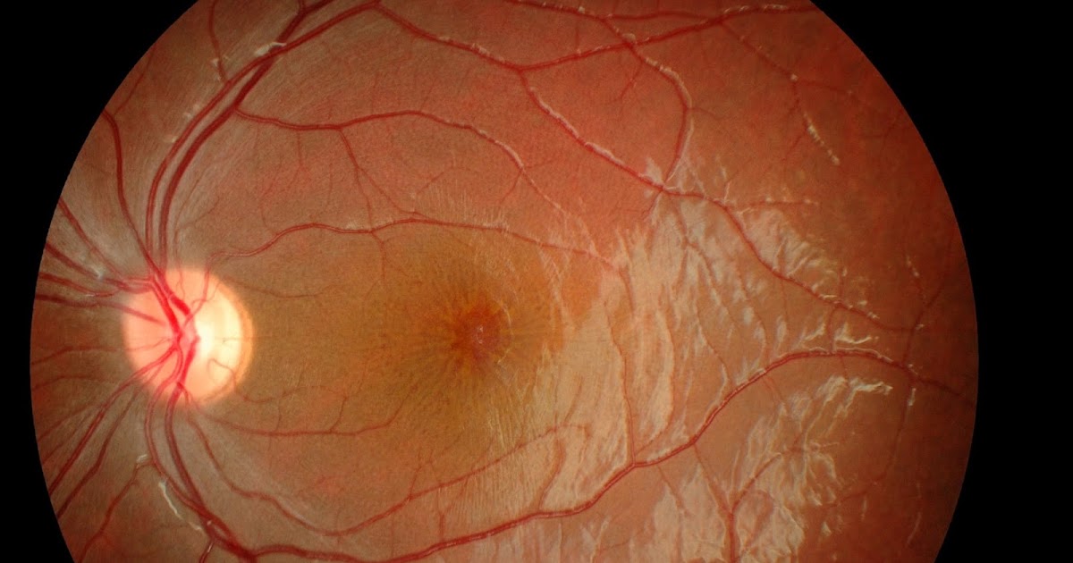 Xlinked juvenile retinoschisis (XLRS)