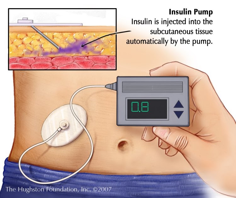 После инъекций инсулина пациент страдающий. Инсулиновая помпа для диабетиков 1 типа. Помпа инсулиновая с системой постоянного мониторирования Глюкозы. Инсулиновая помпа сахарном диабете у детей. Помпа инсулиновая для детей диабетиков 1.
