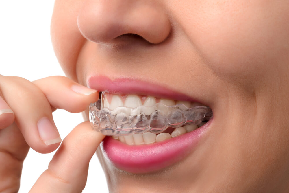 4 Stages of Invisalign Treatment Process