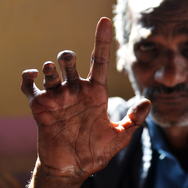 කැස්සකින්, කිවිසුමකින් බෝවෙන ලාදුරු ගැනත් දැනගන්න