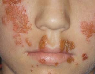 Strep rash - Pictures, Symptoms, Causes, Treatment