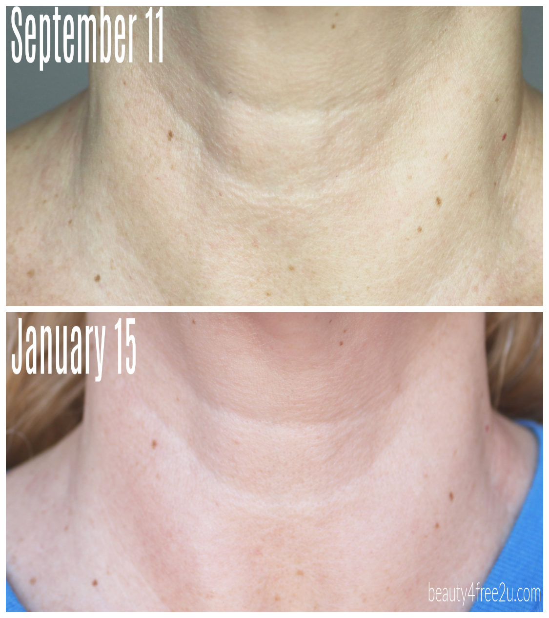 I used the NuFACE device for 120 days and THIS HAPPENED!