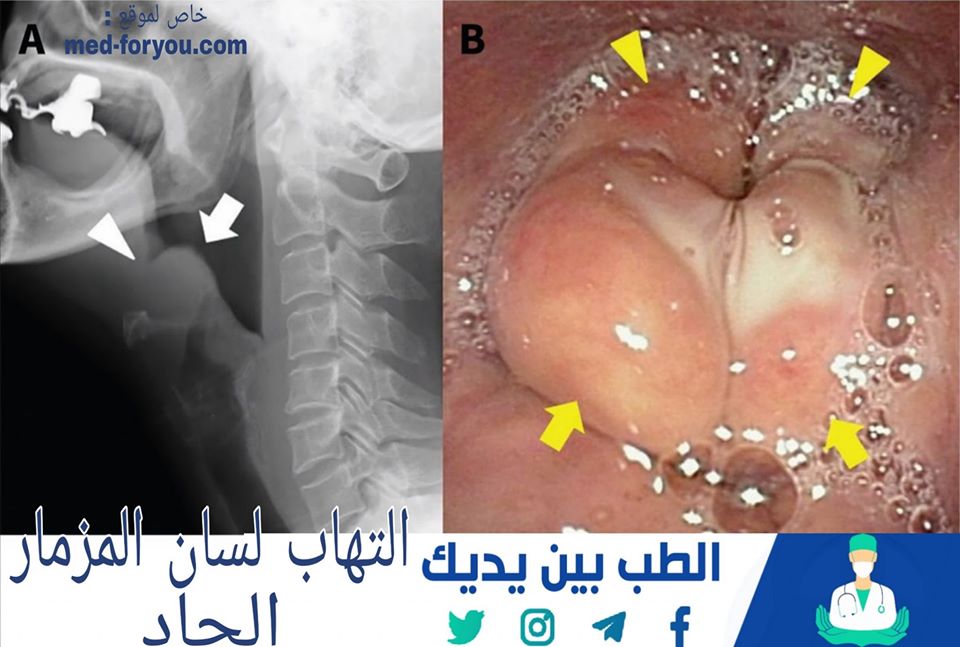 التهاب لسان المزمار الحاد