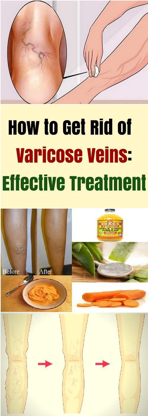 Spectacular Get Rid Varicose Veins Scene Collection