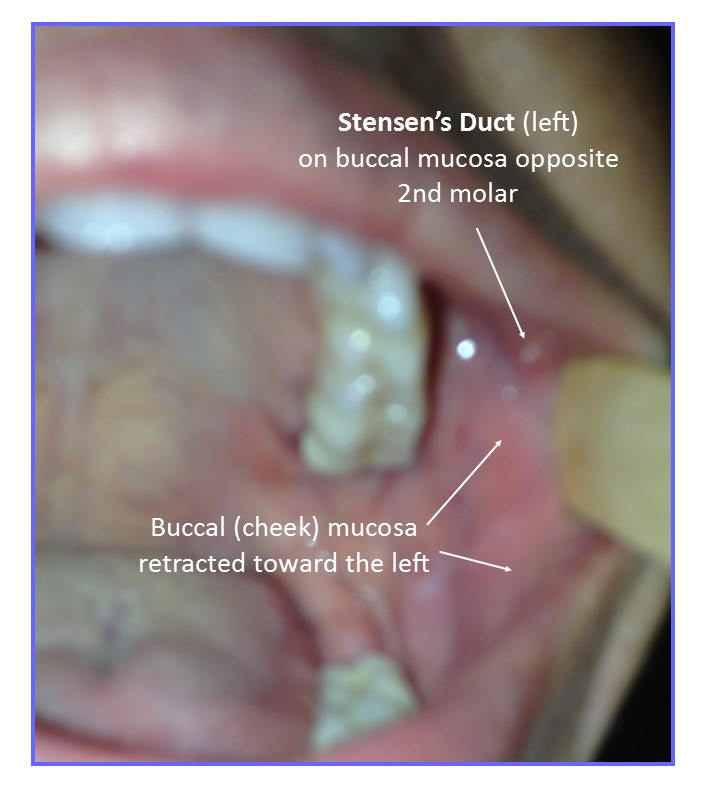 Salivary Stones (or Sialolithiasis)