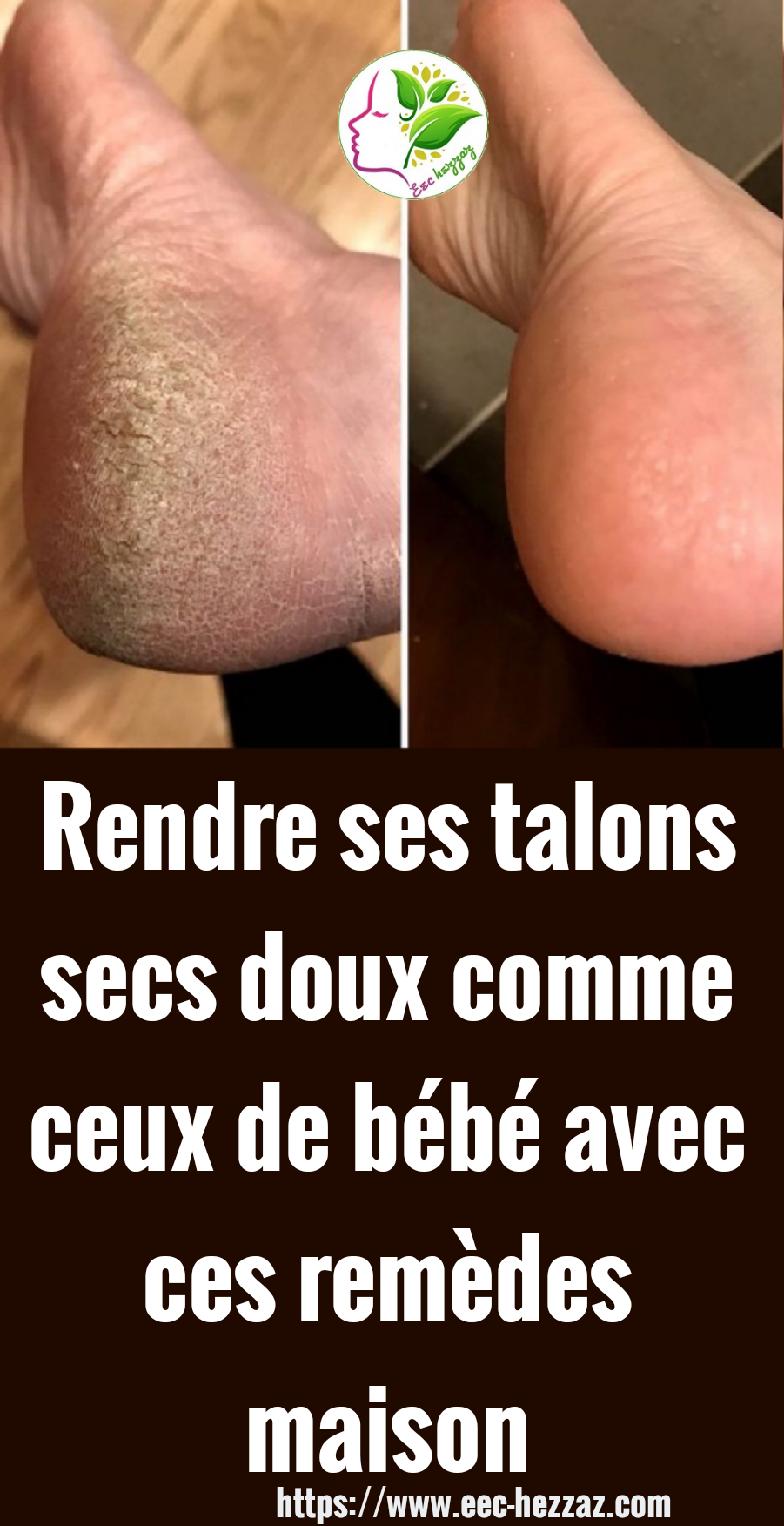 Rendre ses talons secs doux comme ceux de bébé avec ces remèdes maison