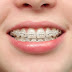 Niềng răng giá bao nhiêu với các loại hình phổ biến?