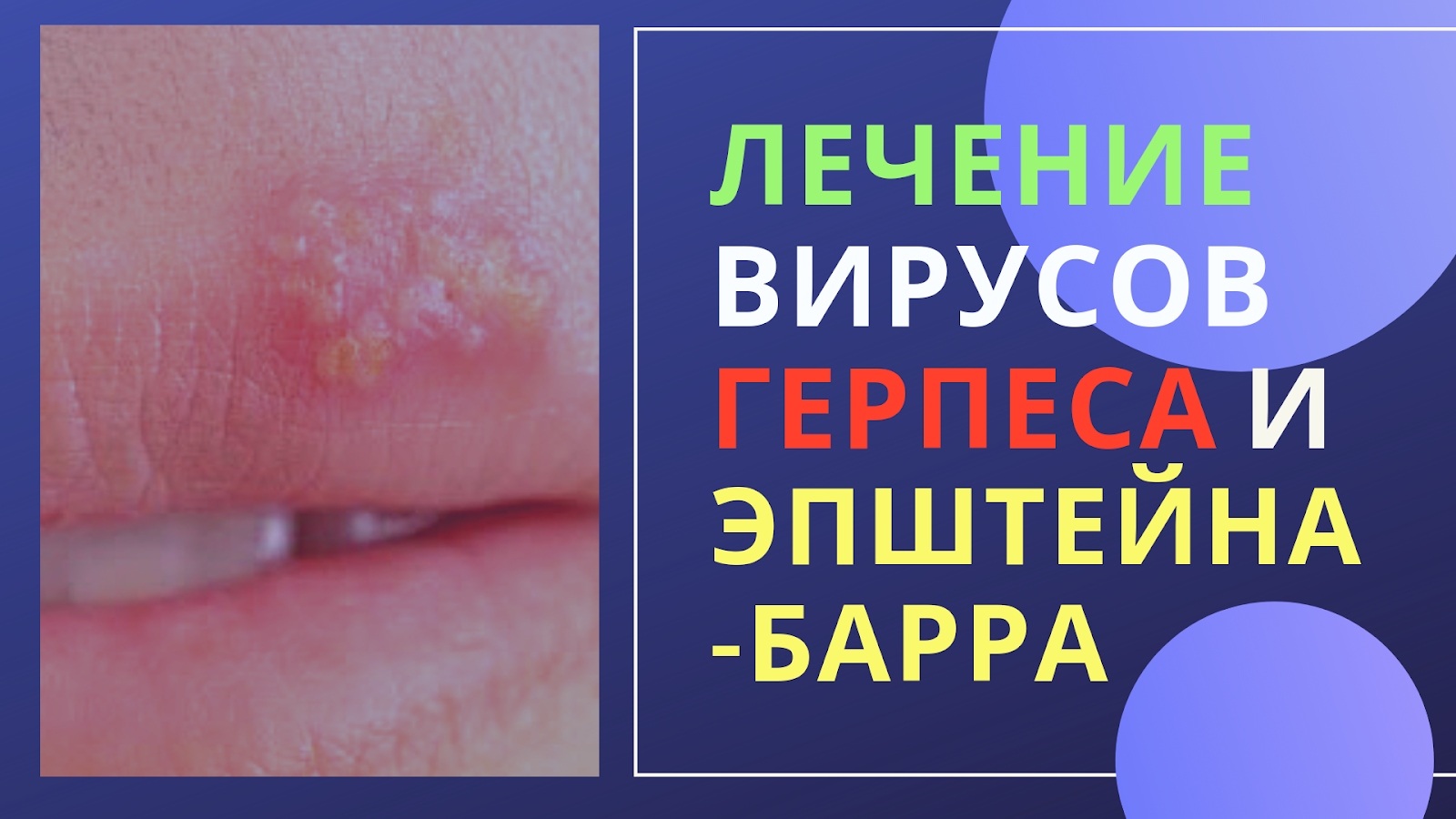Лечение вируса герпеса