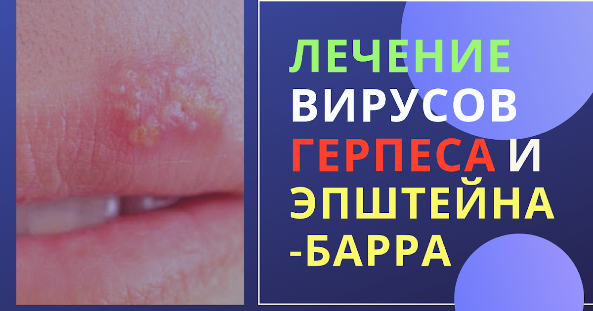 Лечение вируса герпеса