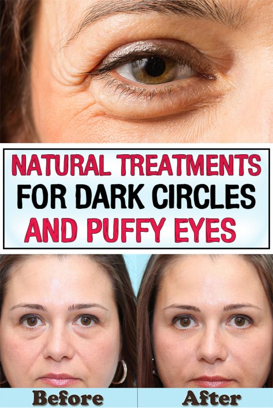 Natural Treatments for Dark Circles and Puffy Eyes Healthy Lifestyle