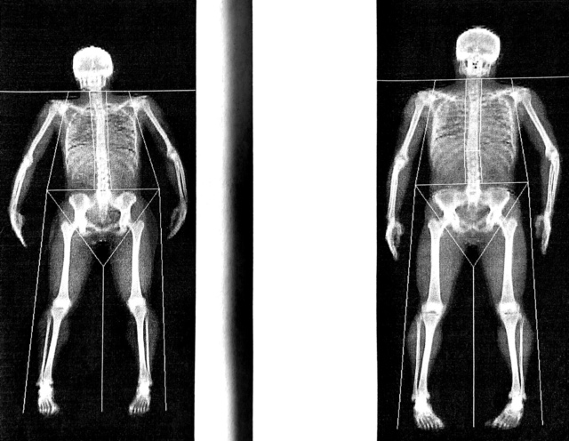 Winter fat or fragile bones? Lotto Soudal riders under the Dexa scan.