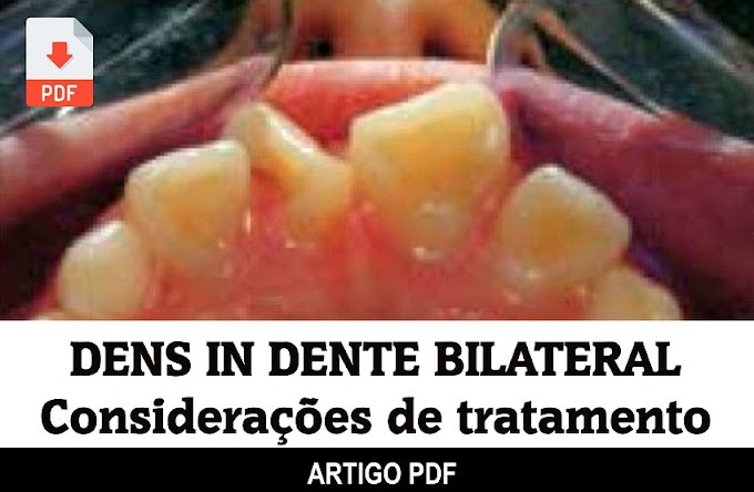 PDF: Dens in Dente bilateral: relato de caso e considerações de tratamento