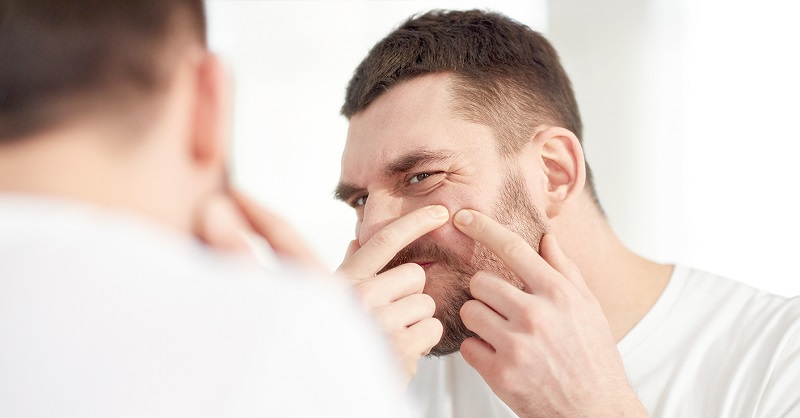 Inilah Cara Menghilangkan Jerawat Secara Alami dengan Cepat 3 Inilah Cara Menghilangkan Jerawat Secara Alami dengan Cepat 3