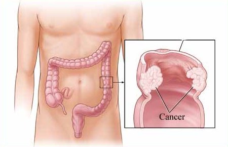 7 Tanda-tanda awal kanser usus yang perlu diberi perhatian ...