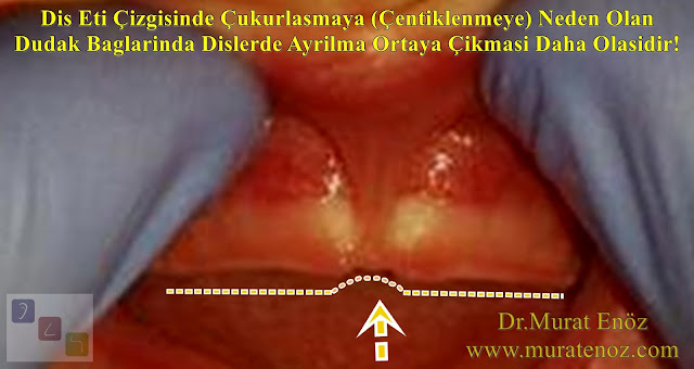 Üst Dudak Bağları Dişlerde Ayrılma (Diastema) ve Diş Çürümesine Nasıl