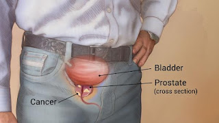 prostate cancer Hindi information-prostate cancer in Hindi