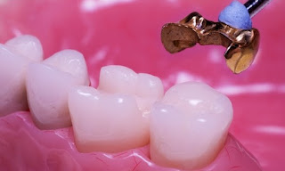 Trám răng bị vỡ cách khắc phục răng vỡ hiệu quả Do-ben-tram-inlay-only-toi-da-la-bao-lau