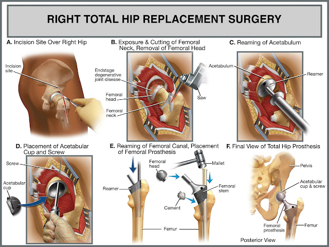 http://orthopedicsindia.com/hip-replacements-ceramic-type-implants.html