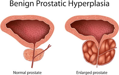 http://www.urologistindia.com/benign-prostate-enlargement/