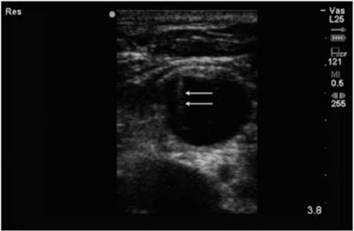 ultrasound guidance