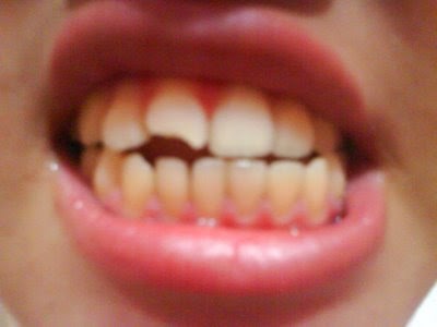 Terbaik No Togel Gigi Patah